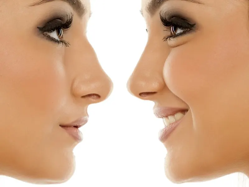مراقبتهای پیش از جراحی بینی