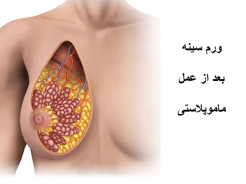 ورم سینه بعد از عمل ماموپلاستی