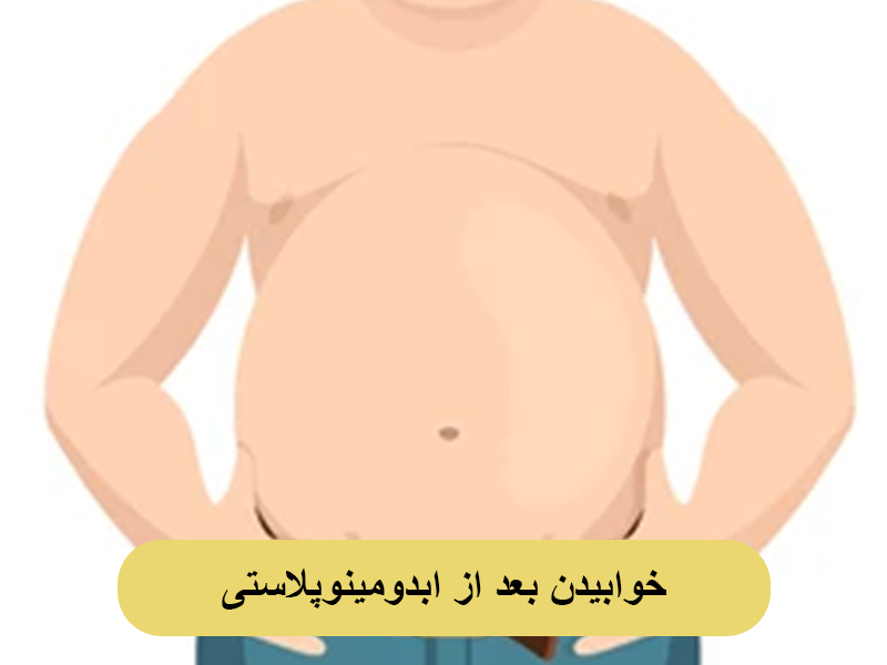 خوابیدن بعد از ابدومینوپلاستی