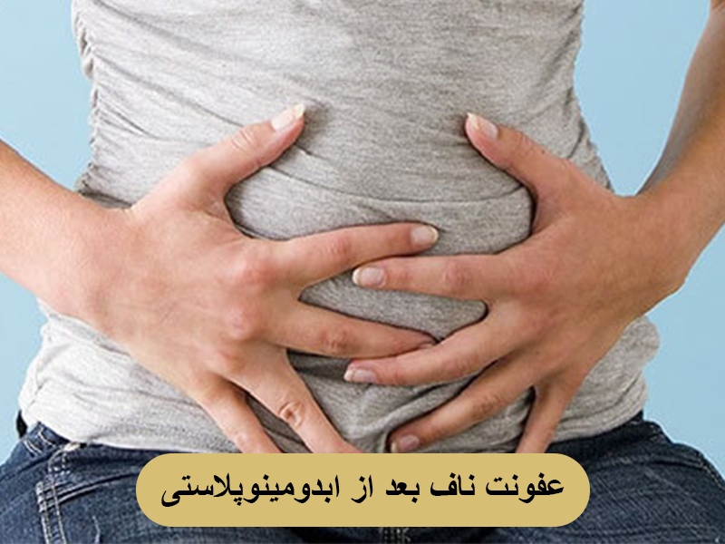 عفونت ناف بعد از ابدومینوپلاستی
