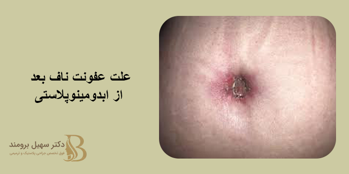 عفونت ناف بعد از ابدومینوپلاستی